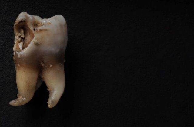 Tooth with a large cavity and chipped crown on a dark surface, shown in close-up view of dental decay.