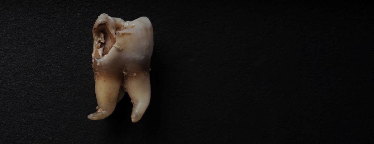 Tooth with a large cavity and chipped crown on a dark surface, shown in close-up view of dental decay.