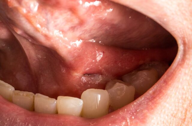 Close-up of an open mouth showing a missing lower tooth and swollen red gums in the front lower jaw area.
