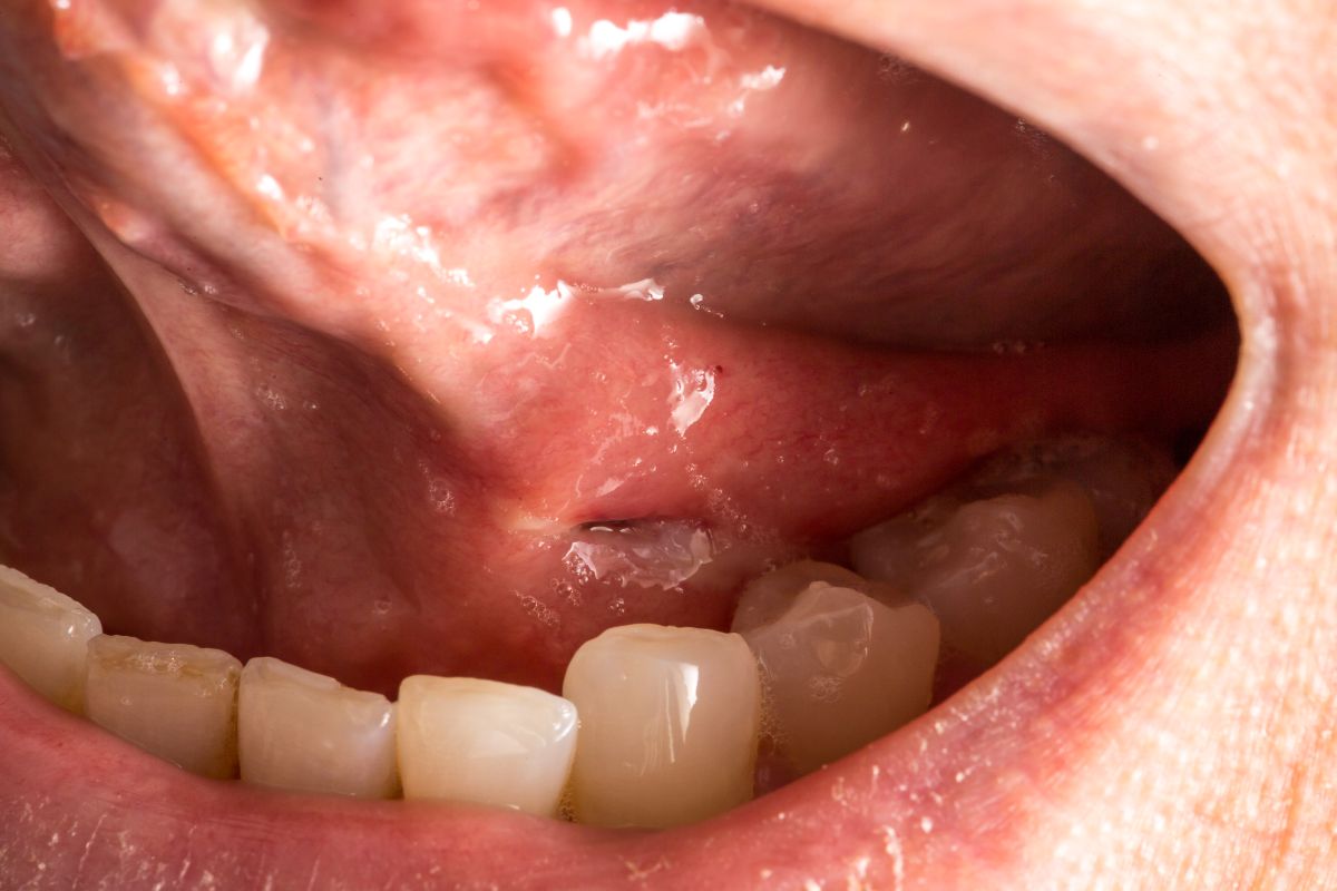 Close-up of an open mouth showing a missing lower tooth and swollen red gums in the front lower jaw area.