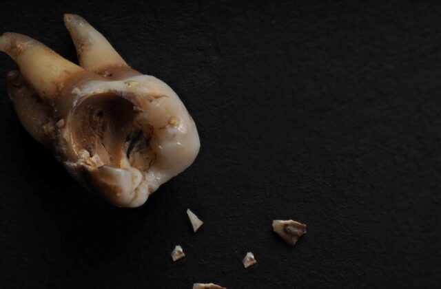 Broken molar tooth with multiple chipped fragments scattered on a dark surface.