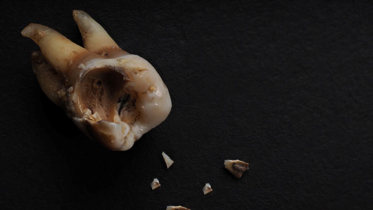 Broken molar tooth with multiple chipped fragments scattered on a dark surface.