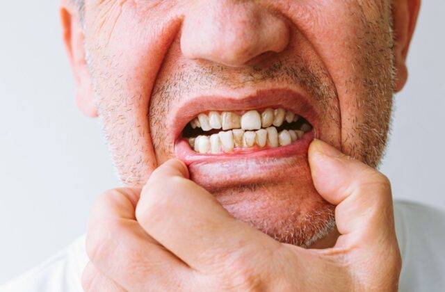 Close-up of a person pulling back their lip to reveal yellowed, crowded teeth.