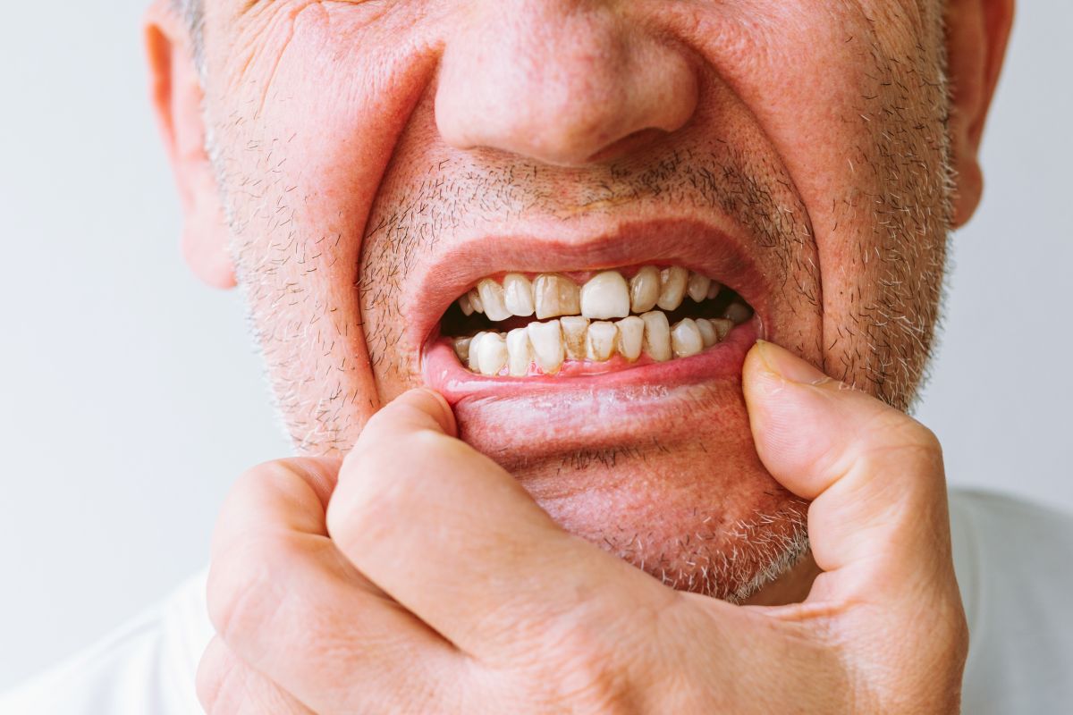 Close-up of a person pulling back their lip to reveal yellowed, crowded teeth.