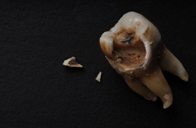 A severely decayed molar with a large cavity and two broken tooth fragments on a dark surface