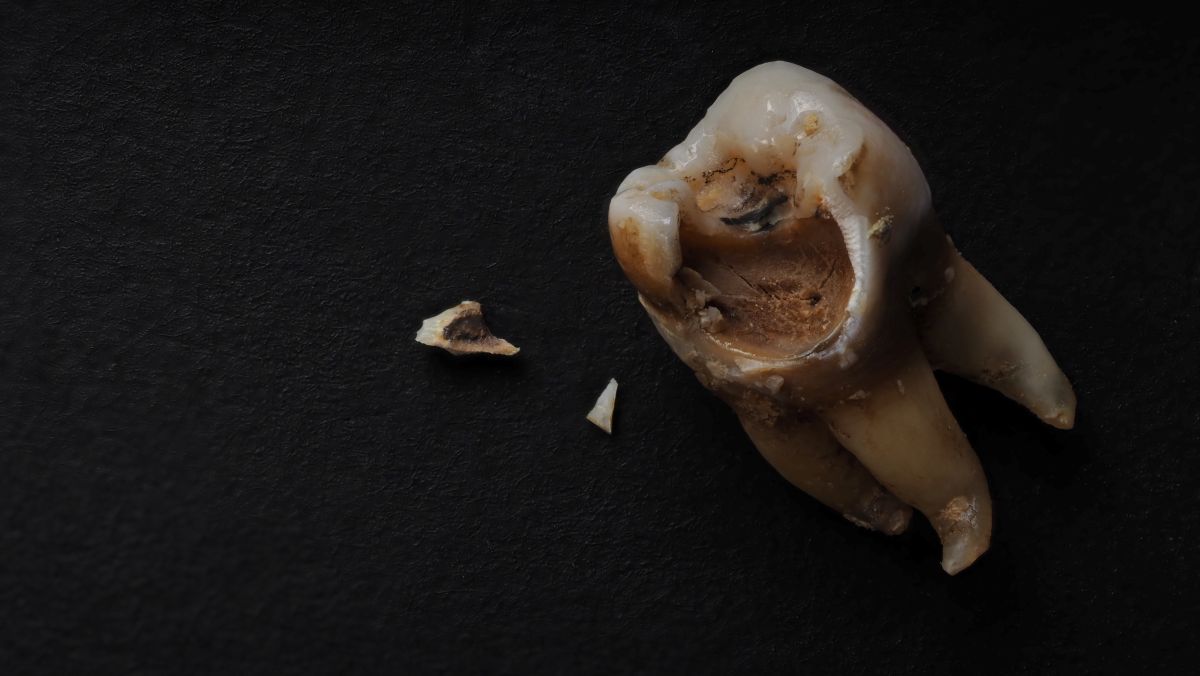 A severely decayed molar with a large cavity and two broken tooth fragments on a dark surface
